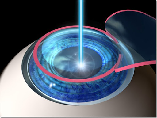 Info_pac_cir_refrac_Lasik