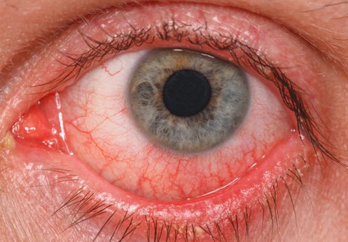 conjuntivitis