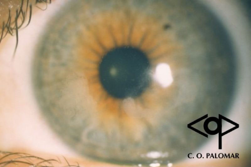 crecimiento_del_epitelio_corneal_en_la_interfase_corneal_postlasik-e